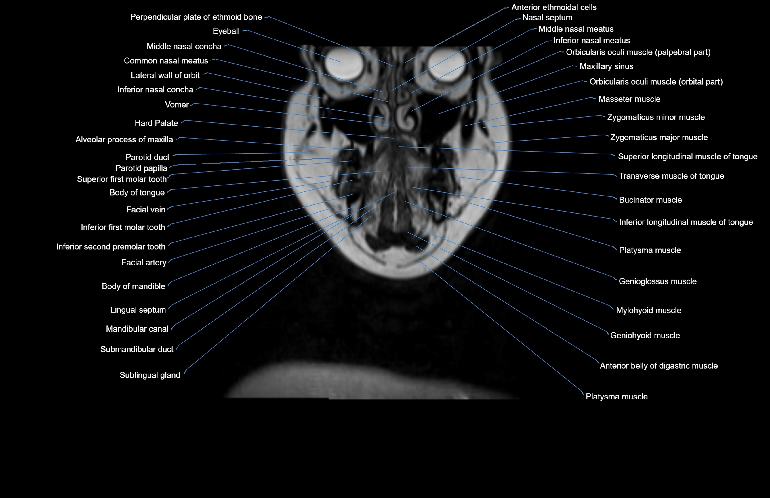 Neck coronal cross sectional MRI anatomy 3T MRI  image-img-00001-00063.webp